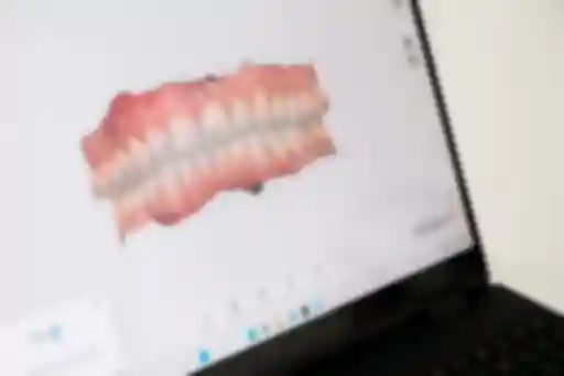 Laptop mit einem digitalen 3D Modell eines Kieferscans zu sehen.